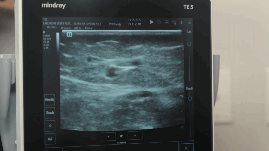 Ultrasound showing varicose veins on legs