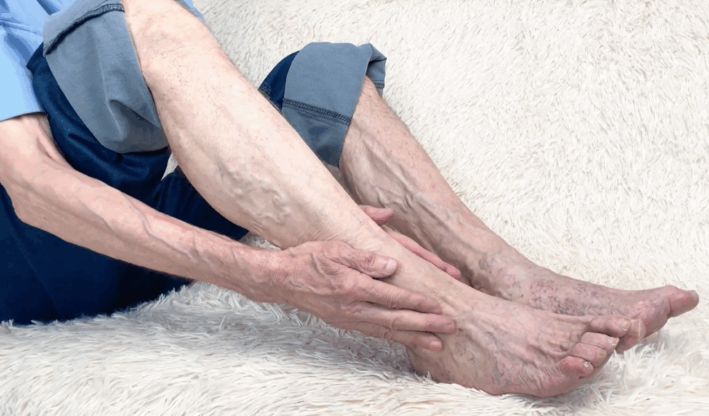 Varicose veins on a female's legs