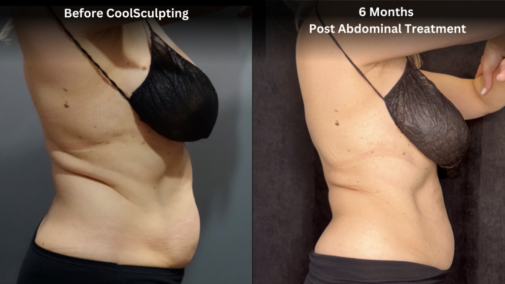 Before and after results of CoolSculpting treatment